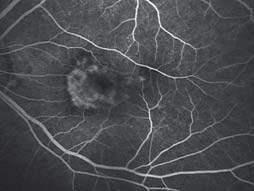 details of retinopathy in central and peripheral areas of the patient's