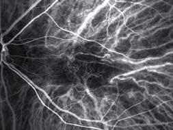 BRVO (Branch Retinal Vein Occlusion) - with 60 degrees wide-angle adaptor