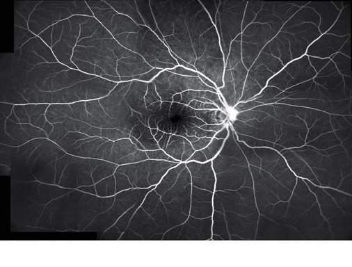 pathology in peripheral area of retina, as well as macular area.
