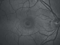 of retina.