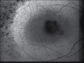Glaucoma by looking at the RNFL.