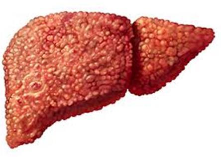 Chronic liver diseases Normal