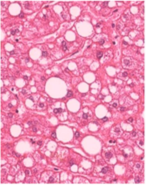 Estimation of steatosis in the