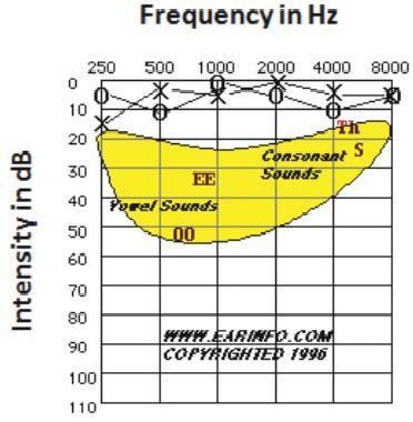 Due to individual differences, all thresholds up to 20 db are considered as normal. Figure 1 shows the audiogram of a normal hearing person.