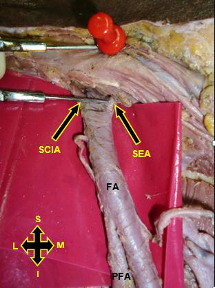 dissected carefully. In five lower limbs, the femoral artery and its branches had got cut during dissection by students and hence were not included in this study.