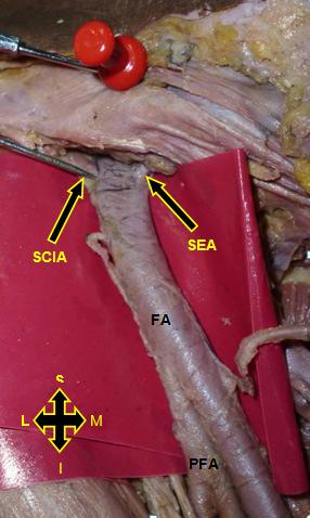 The anterior superior iliac spine (ASIS) and pubic symphysis (PS) were identified and marked with the help of coloured pins.