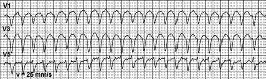 During this short period, electrical activity of atria becomes clearly visible on ECG.