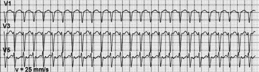 On the other side, the use of class I antiarrhythmic drugs is known to slow down the atrial rate while the AV conduction remains the same or increases.