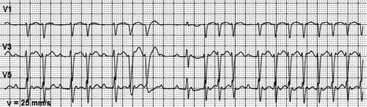 The His- Purkinje system cannot properly conduct impulses with rate beyond 200 per minute and aberrant conduction with wide QRS complex occurs (Fig. 2a.).