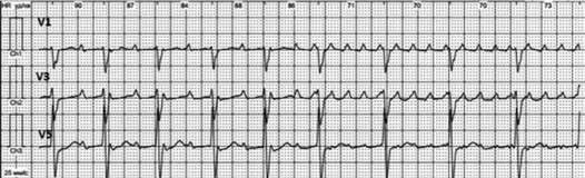 However, rarely AFL occurs with 1:1 conduction: extraordinary high heart rate around 225 bpm, and some episodes of irregular ventricular conduction, which can be seen during further observation (Fig.