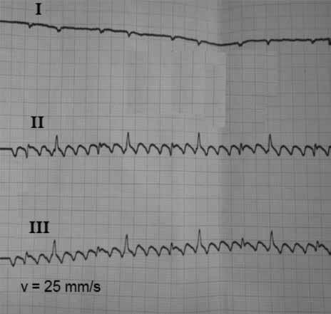 changed slightly. Interpretation of the atrial flutter recordings sometimes is complicated when ECG shows pauses of various duration due to episodically worsening of AV conduction.