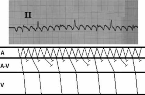 Long pauses, which can be seen on ECG, are clinically important signs of impaired AV conduction and may be considered as indication to implantation of the pacemaker.