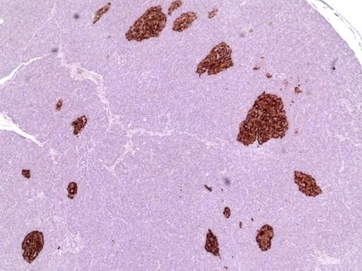 Figure 4. Histological specimen of pancreas (x200 magnification). Diffuse appearance of enlarged beta cells within the pancreatic islets, containing pleomorphism and prominent nuclei.