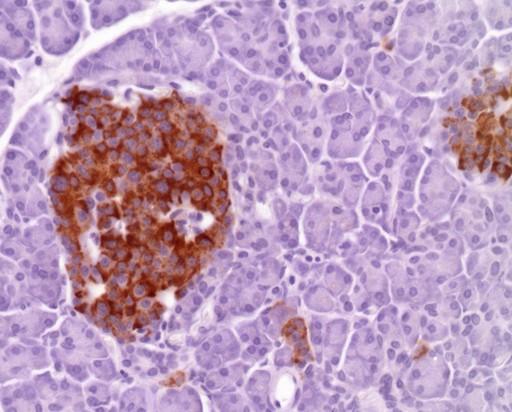 Recently, adult onset nesidioblastosis has become incorporated into the description of non-insulinoma pancreatogenous hypoglycaemic syndrome (NIPHS) [3] and there are 71 cases of adult