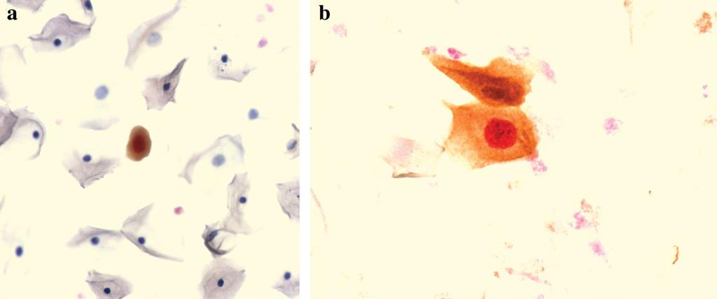 CINtec PLUS SENSITIVITY AND SPECIFICITY Fig. 1. a: Dysplastic cell interpreted as positive for CINtec staining exhibits nuclear Ki-67 (red chromogen) and cytoplasmic p16 (brown chromogen), 340.