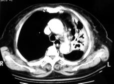 67 Kuo-Chin Kao, et al unusual case of pulmonary actinomycosis with recurrent life threatening massive hemoptysis.