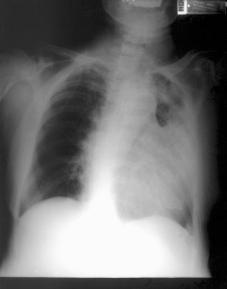 CASE REPORT An 81-year-old woman had history of dry cough for 1 month, left-sided thoracic pain and dyspnea.