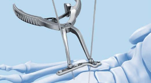 Stop feature allows quick and easy preliminarily fixation of the plate to the bone, eliminating the need for plate holding forceps.