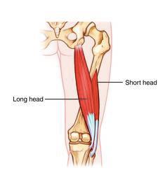 Biceps femoris tendinopathy (chronic inflammation and dysfunction of the tendon related to overuse) is a common, often misdiagnosed injury which plagues many runners.