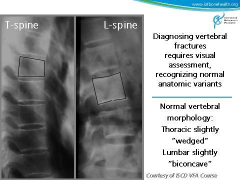 Slide 46 It is important to recognize normal morphology of vertebra. Note that lumbar vertebra have a slightly biconcave shape, thoracic vertebra slightly wedged.