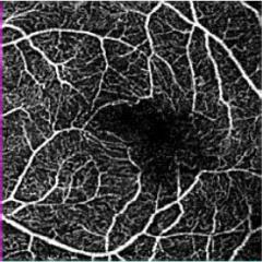 AngioPlex maps: CNV lesion Superficial