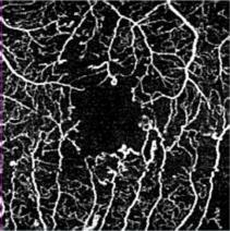 (micro-aneurysm, ischemia) within the retina Superficial Retina Deep