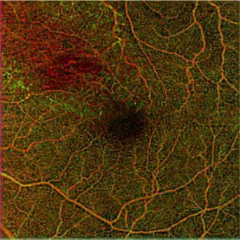 Angiogram 10 mins AngioPlex Map Color Depth Retina
