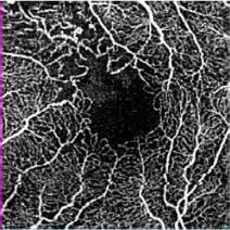 regions of abnormal vasculature (micro-aneurysm,