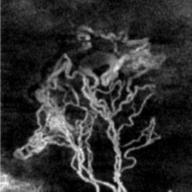 AMD Neovascularization in Mactel Micro-aneurysms and ischemia in DR Occlusions