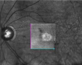 Clinical case #1: Wet AMD with CNV 64y