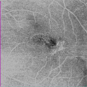 Clinical case #1: Wet AMD with CNV 64y Male, OS