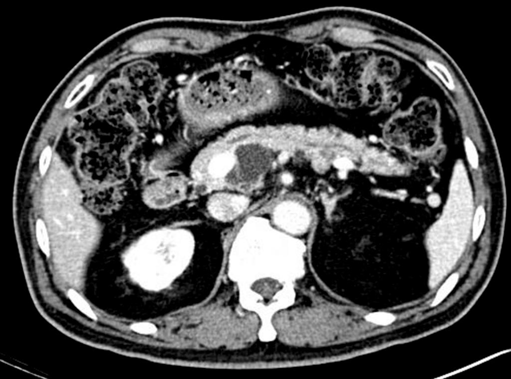 154 Korean J Hepatobiliary Pancreat Surg Vol. 18, No. 4, November 2014 Fig. 2. Radiologic findings of multifocal intraductal papillary mucinous neoplasms.
