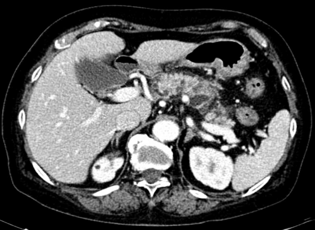 If there whereas benign-looking BD-IPMNs were left intact within was no change in lesions in the remnant pancreas, CT the remnant pancreas.