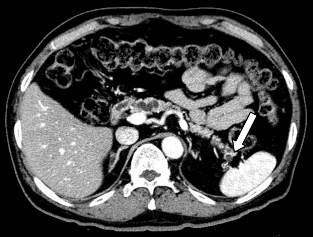 A 68 years-old male patient underwent pylorus-preserving pancreaticoduodenctomy due to increase in size of multifocal BD-IPMNs with mural nodules in the head.