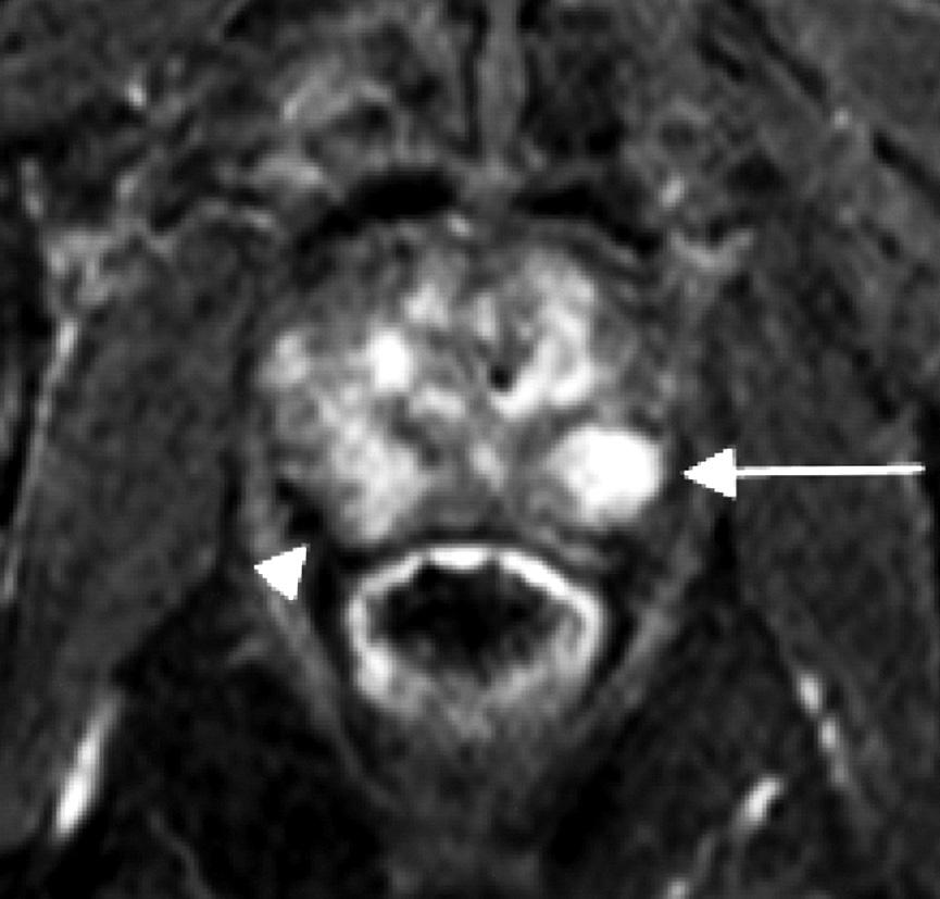A T2- weighted MR image (a) shows a generalized decrease in signal in the right peripheral zone (arrowhead) and a focal decrease in signal in the left peripheral zone (arrow).