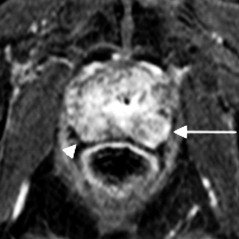 An early phase image that was taken at 30 s of the dynamic contrast-enhanced study (b) exhibits a generalized enhancement in the right peripheral zone (arrowhead) and focal enhancement corresponding
