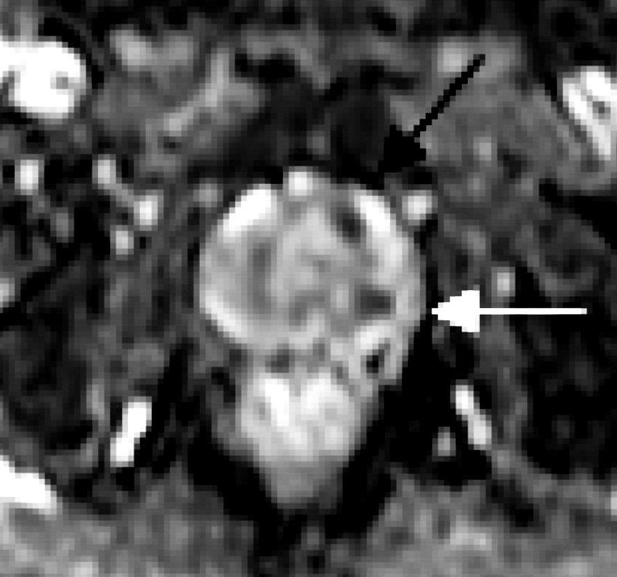 A diffusion-weighted image (d) delineates a focal mass in the left peripheral zone (white arrow) and the left central gland (black arrow).