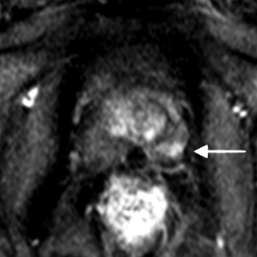 A T2-weighted MR image (a) shows a wedge-shaped lesion with a mild decrease in the signal in the left peripheral zone (arrow); the lesion was scored as 2, probably not cancer.
