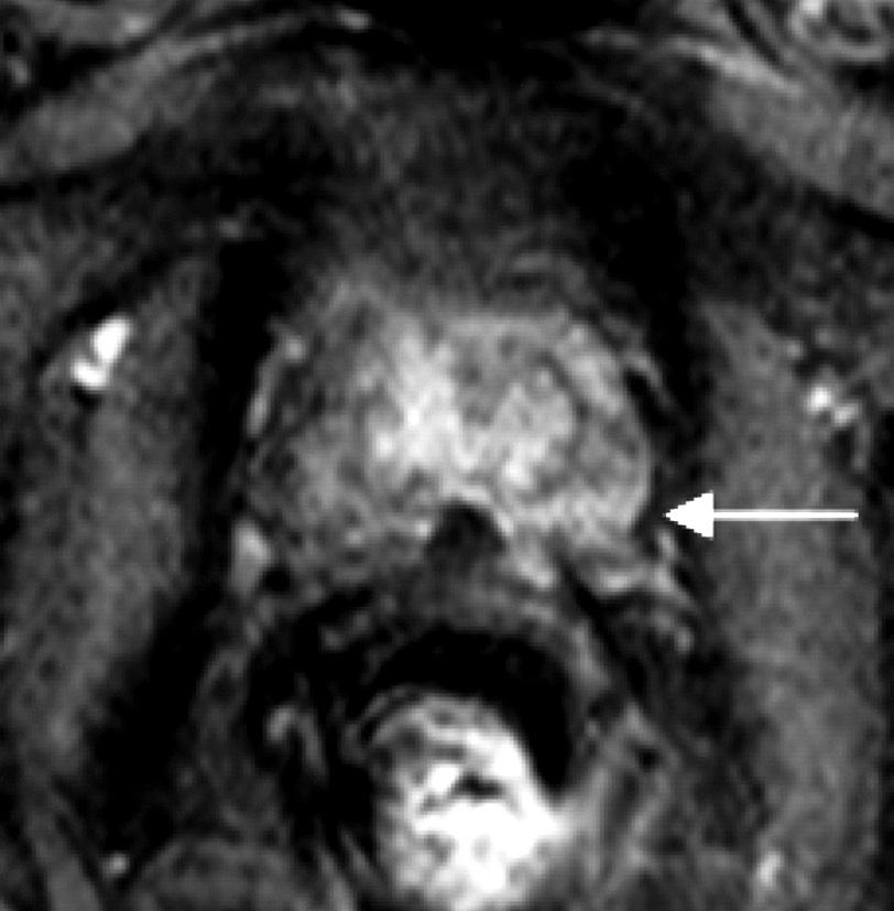 A late phase image that was taken at 180 s of the dynamic study (c) exhibits a prolonged enhancement of the lesion (arrow); the lesion was scored as 3, probable cancer.