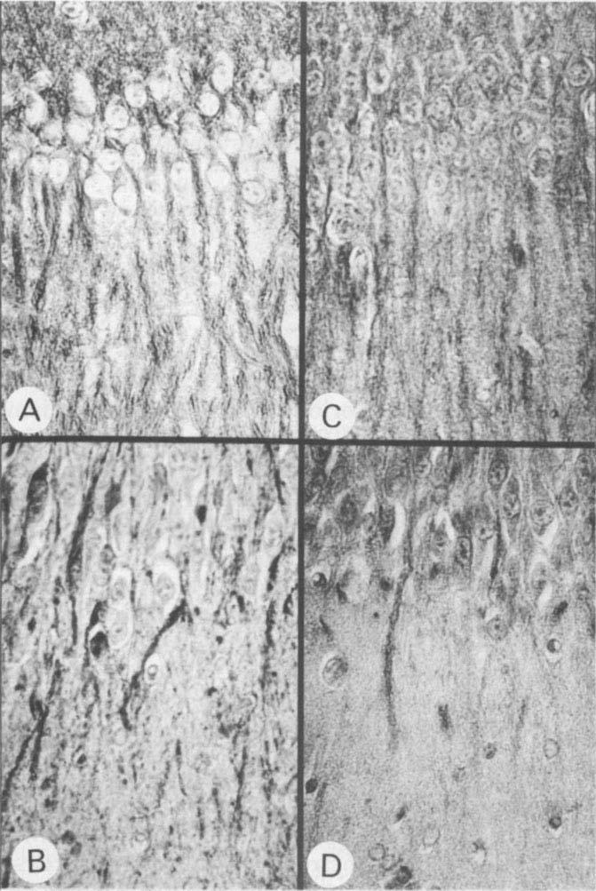 42 FOCAL CEREBRAL ISCHEMIA Mayo Clin Proc, January 1987, Vol 62 volemic hemodilution to the clinical setting after demonstrating a reduction in blood viscosity and shearing forces and a resultant
