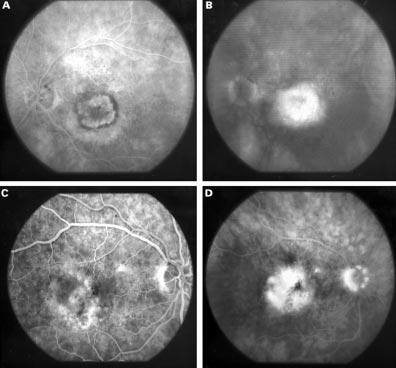 240 Lafaut, Bartz-Schmidt, Vanden Broecke, et al Figure 1 (A) Early phase and (B) late phase fluorescein angiogram of a classic choroidal neovascular membrane in age related macular degeneration from