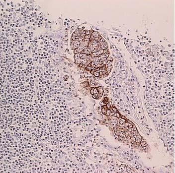 tumour cells. A: micrometastasis > 0.