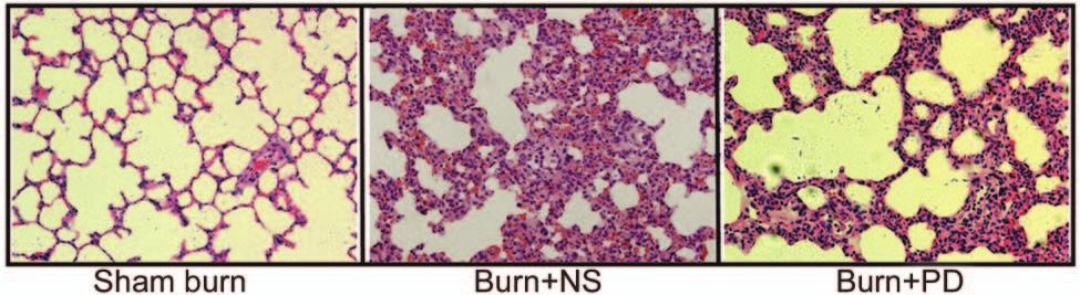 Fig. 2. Effect of polydatin (PD) on lung histopathology changes in burn-injury rats.