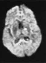 1: Diffusion-weighted magnetic resonance images in a 63-year-old woman with a 1-day history of right hemiparesis showing 2 causes of hyperintense signal (acute cerebral infarction and anisotropy