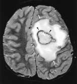 HINMAN AND PROVENZALE Seizure foci Although infrequently seen on diffusion-weighted imaging, epileptogenic foci in patients with complex partial status epilepticus are a non-ischemic cause of