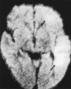 A: Axial T 2 -weighted image shows left hemisphere mass with hypointense rim (arrowheads), commonly seen with abscesses.