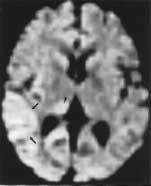 5 As such, diffusion-weighted imaging abnormalities due to continuous seizures are potentially reversible, but if prolonged, continuous seizures can cause irreversible