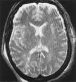 In the absence of a clinical history, the distribution of lesions is a primary means FIG. 5: MRI scans in an 8-year-old girl with status epilepticus.