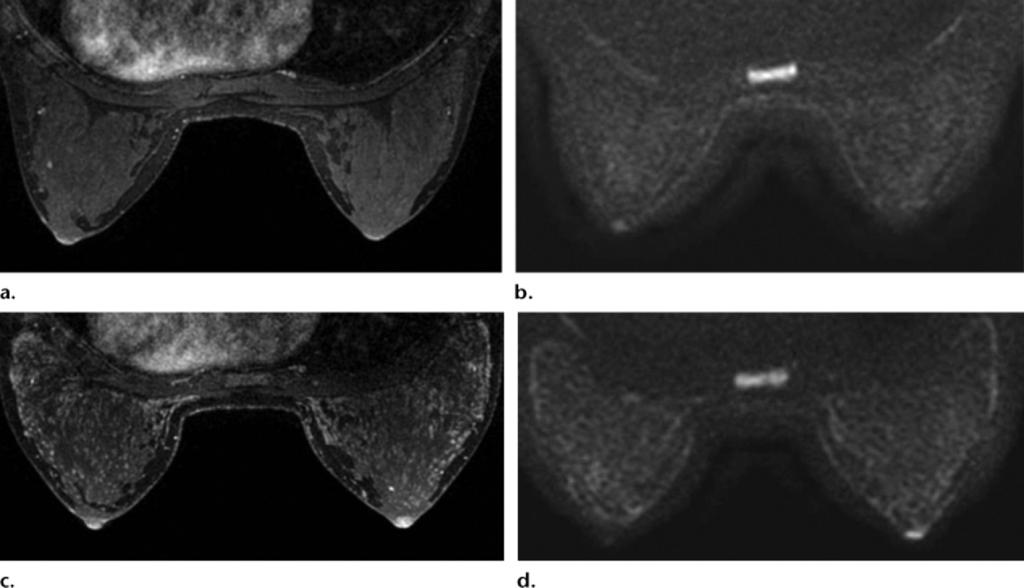 RG Volume 31 Number 4 Woodhams et al 1069 Figure 8. Changes in signal intensity and ADC value during the menstrual cycle in a 27-year-old woman. A focal asymmetric density was seen at mammography.