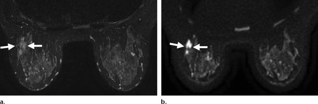 RG Volume 31 Number 4 Woodhams et al 1075 Figure 15. Intraductal papilloma. (a) Contrast-enhanced T1-weighted MR image (VIBRANT, TR/TE = 6.5/3.1, flip angle = 12, bandwidth = ±41.